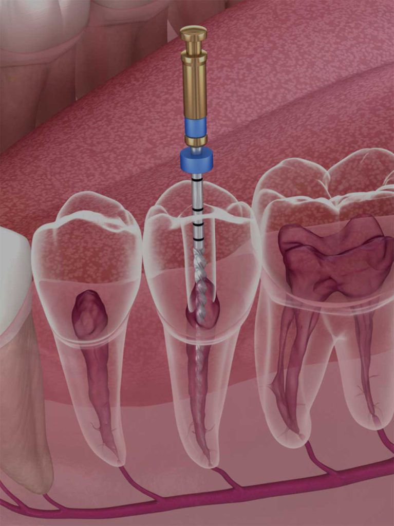 3D Root Canal