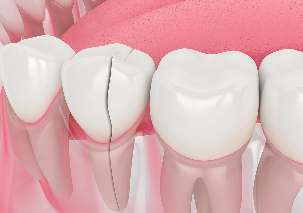 Cracked Tooth Treatment in Long Beach CA Area