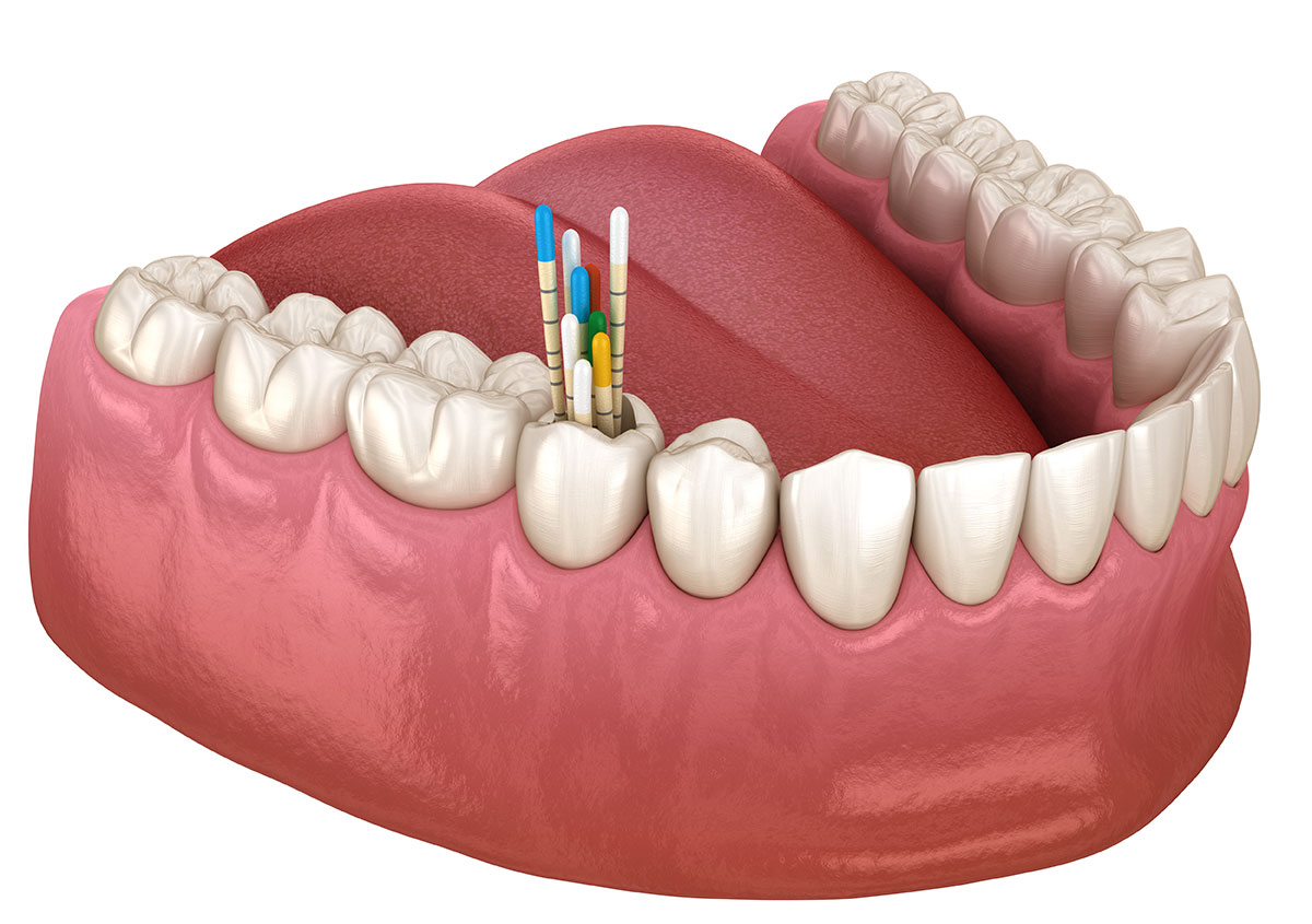 Endodontic Success Rate in Long Beach Area