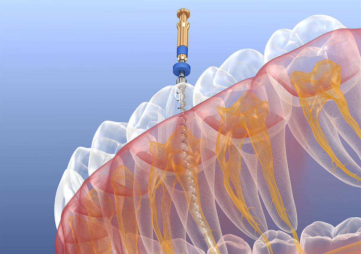 Root Canal Specialist in Long Beach CA Area