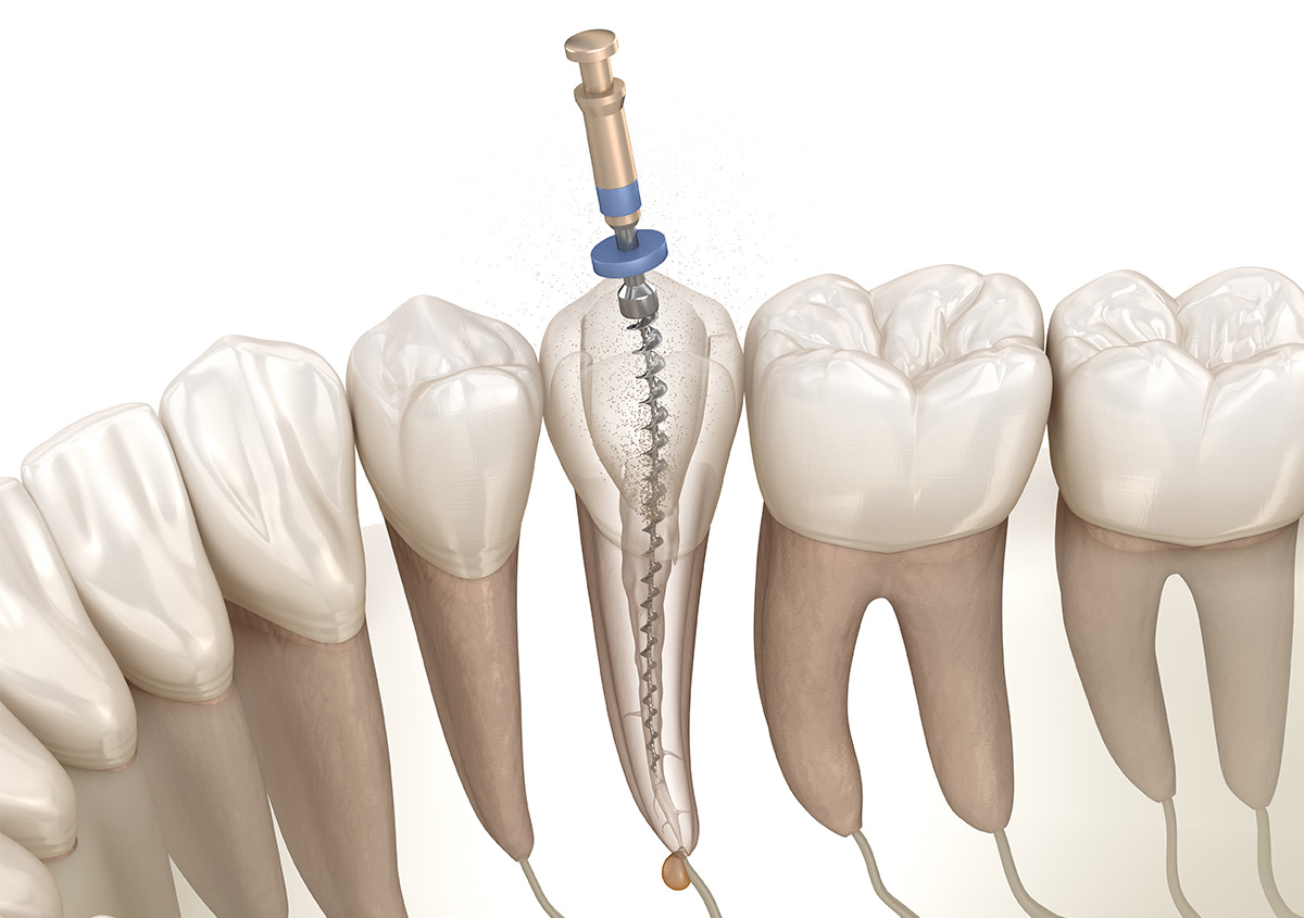 Affordable Root Canal in Long Beach CA Area