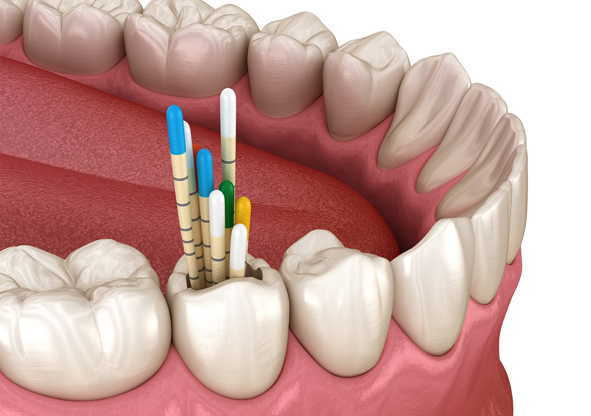 Failed Root Canal Treatment in Long Beach CA Area