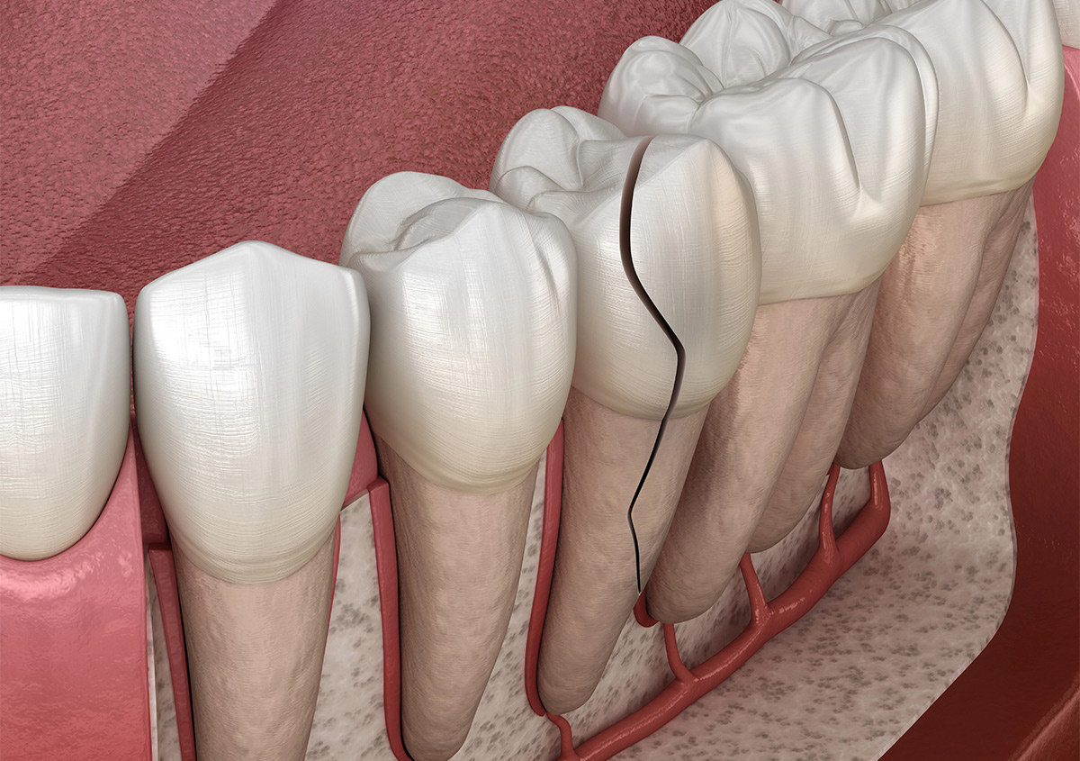 Fractured Tooth Root Repair in Long Beach CA Area